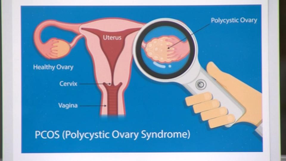 Everything you need to know about Polycystic Ovary Syndrome