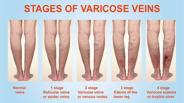Everything you need to know about varicose veins